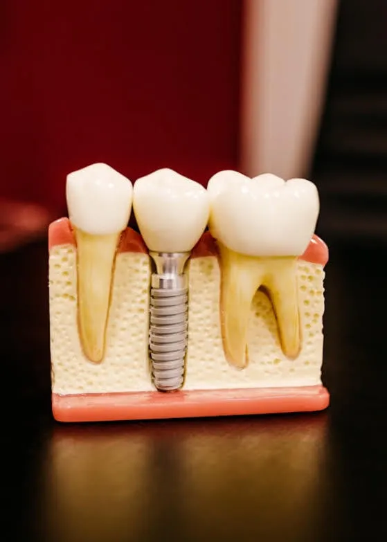 Modelo anatómico de un implante dental de titanio en la Clínica Dental Dra. Beatriz Gómez