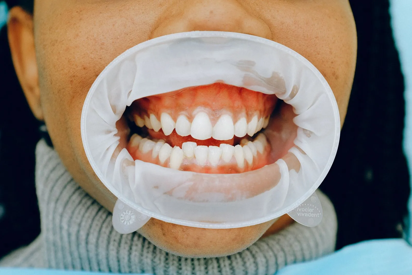 Boca con separador durante una revisión de encías en la Clínica Dental Dra. Beatriz Gómez